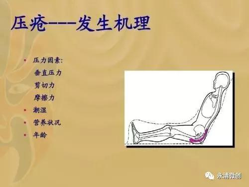 慢性壓瘡的預(yù)防