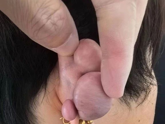 瘢痕疙瘩越來越大怎么辦？應(yīng)如何治療？