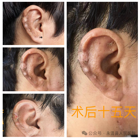 瘢痕疙瘩越來越大怎么辦？應(yīng)如何治療？