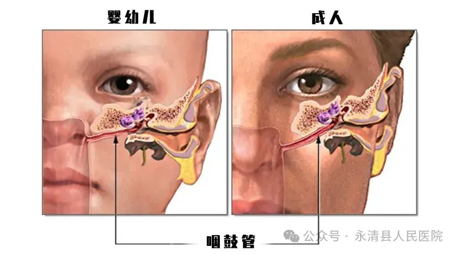 分泌性中耳炎——不流膿的中耳炎